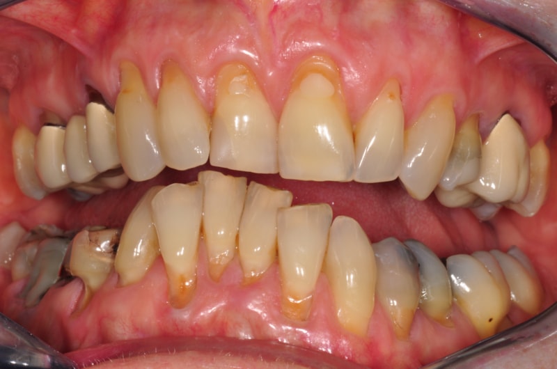 Zahnfehlstellungen und teilweise nich mehr erhaltungsfähige Zähne durch immer wieder